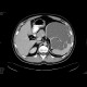 Splenic cysts, congenital, epithelial: CT - Computed tomography